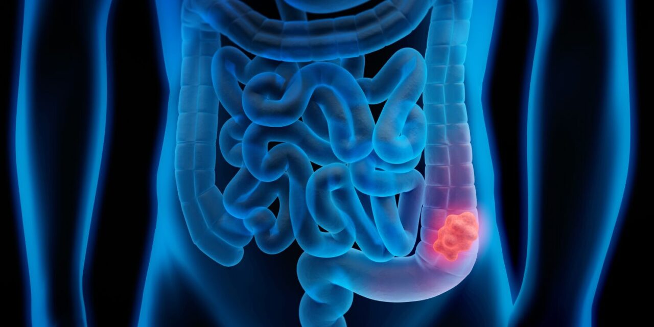 COLORECTAL CANCER – WHO IS AT RISK?