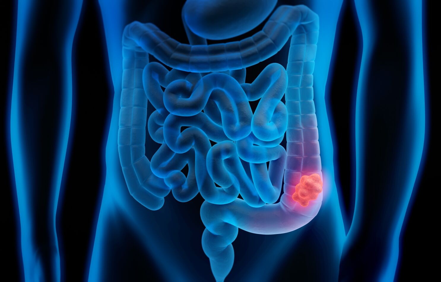 COLORECTAL CANCER WHO IS AT RISK? Acupath Laboratories