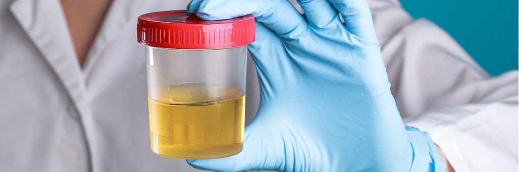Differences Between Urinalysis Urine Cytology AcuURO17