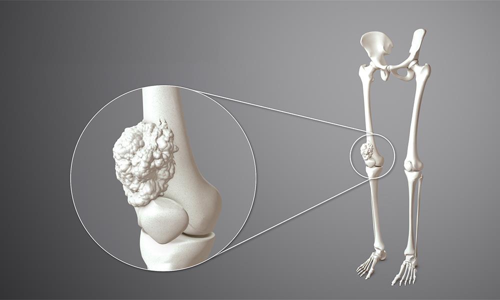 How common is Bone Cancer?